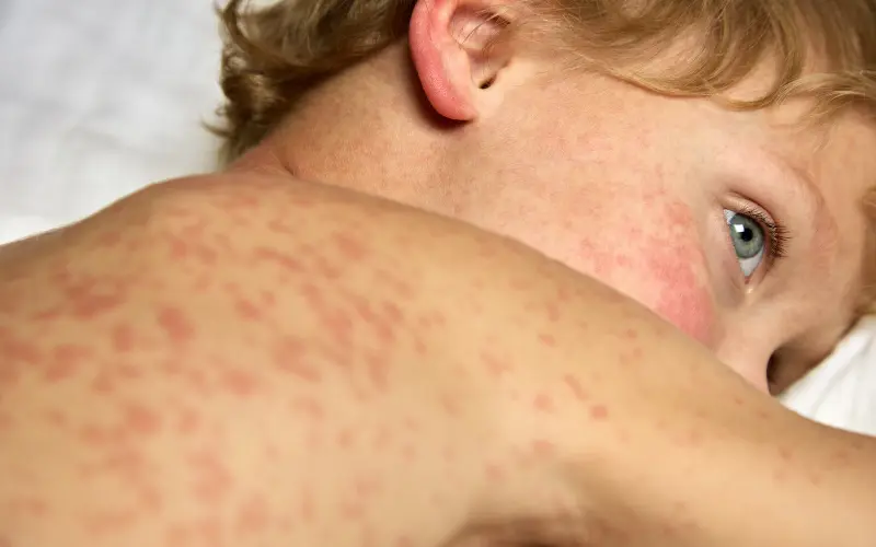Atópiás dermatitisz (ekcéma) természetes kezelése - Pranagarden